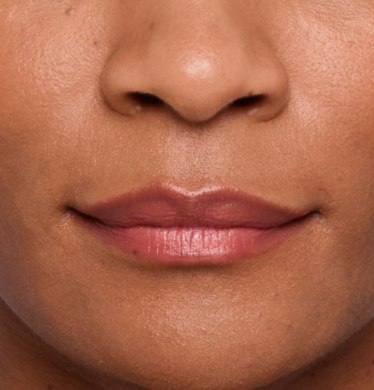 Image of a model before and after treatment with the JUVÉDERM Collection of Fillers. 