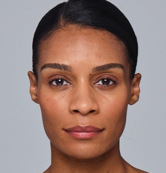 Image of a model before and after treatment with the JUVÉDERM Collection of Fillers. 