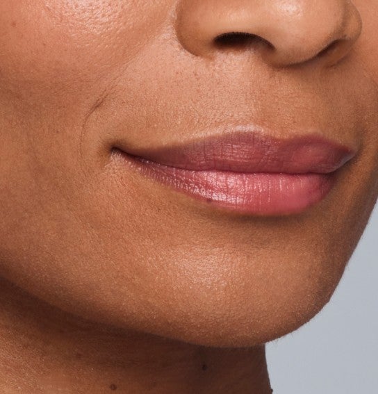 Image of a model before and after treatment with the JUVÉDERM Collection of Fillers. 