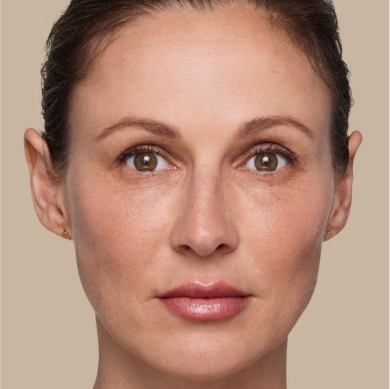 Image of a model before and after treatment with the JUVÉDERM Collection of Fillers. 