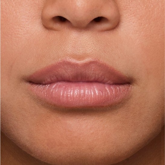 Image of a model before and after treatment with the JUVÉDERM Collection of Fillers. 