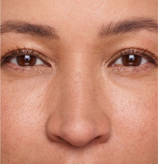 Image of a model before and after treatment with the JUVÉDERM Collection of Fillers. 