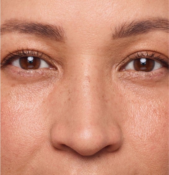 Image of a model before and after treatment with the JUVÉDERM Collection of Fillers. 