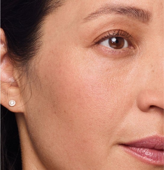 Image of a model before and after treatment with the JUVÉDERM Collection of Fillers. 