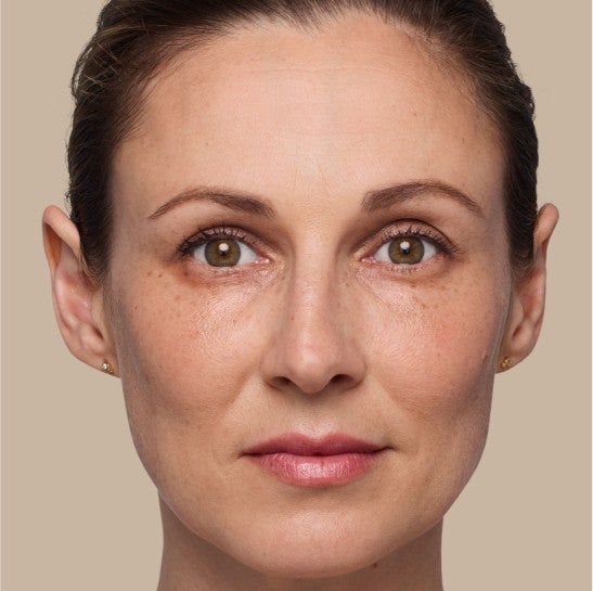 Image of a model before and after treatment with the JUVÉDERM Collection of Fillers. 