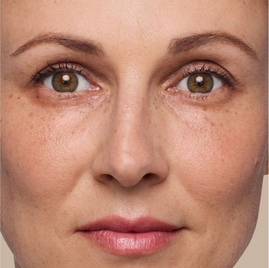 Image of a model before and after treatment with the JUVÉDERM Collection of Fillers. 